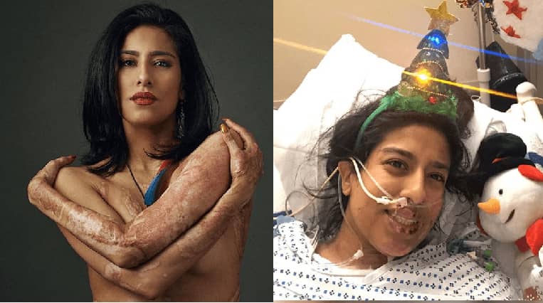 Belly Dancer Who Tragically Burnt Half Of Her Body Now Embracing Her New Look